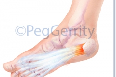 325 Plantar Fasciitis Pathology