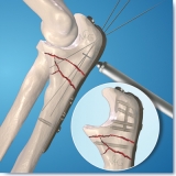 Olecranon-1