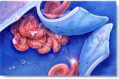 051-Vein-Thrombosis-clot