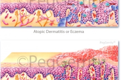 Skin-Eczema-and-Psoriasis-042-and-292