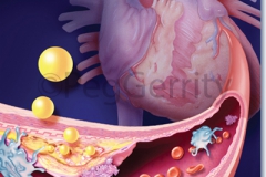 092 Cardiovascular Disease and Plaque