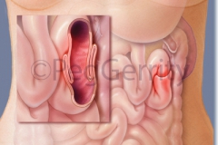 Intussusception-Image-233