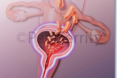 Urinary-Tract-Infection-of-Bladder-Image-154