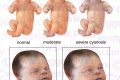 203V-Newborn-Cyanosis