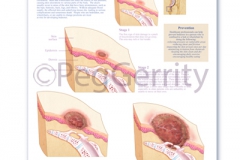 Bedsore Progression Poster 384V