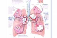 Lung Cancers Poster 493