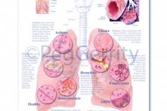 Respiratory Diseases Poster 494