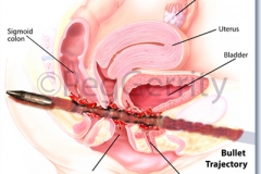 087ML-Gunshot-Wound-1