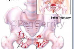 087ML-Gunshot-Wound-2