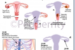 087ML-Gunshot-Wound-3