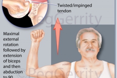 344-Rotator-Cuff-Re-Tear-A