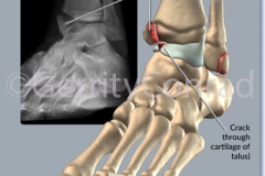 CMG-01-Car-Wreck-Ankle-A