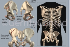 CMG-01-Car-Wreck-Fractures-B