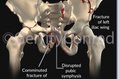 CMG-01-Car-Wreck-Fractures-C