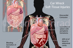 CMG 1-Car-Wreck-Soft-Tissue-Injuries-A