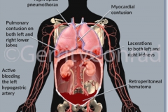 CMG-01-Car-Wreck-Soft-Tissue-Injuries-B