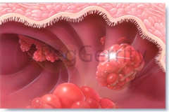 022 GI Polyps