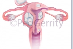 434-Fibroids