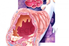 161 bronchiectasis