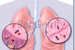 331V-Infarct-and-Pulmonary-Emboli