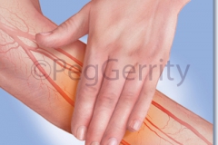 Diabetic-Arm-Rub-w-Arteries-Image-267