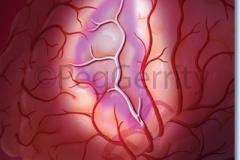 Ischemic-Stroke-w-Penumbra-Image-409