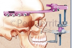 Maxillary-Distraction-Surgery-Image-002