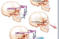 002R-Maxillary-Distraction