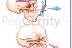 002V-Maxillary-Distraction