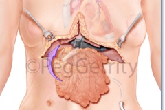 Omentum Flap over LVAD Surgery (323)