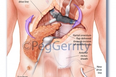 Rectal Flap over LVAD Surgery (323)