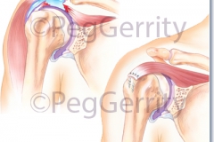 356-Rotator-cuff-tear-and-repair