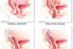 437-and-438-Vag-Vault-Prolapse-Repair