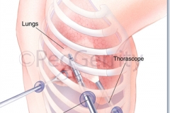 441-Thorascopic-Surgery