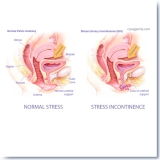 Stress Urinary Incontinence Medical Illustration by Peg Gerrity