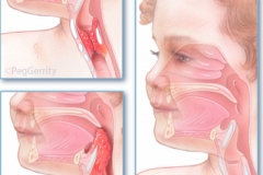 223 Croup and Epiglottitis