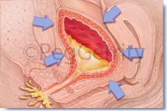 312V Overactive Bladder