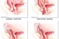 437, 438 Vaginal Vault Prolapse Repair