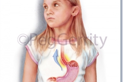 Gastroesophageal-Reflux-GERD-261